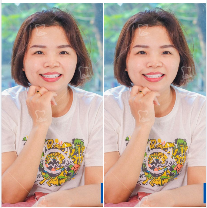 Tuyệt tác răng sứ Nacera tạo nụ cười chuẩn tự nhiên cho chị đẹp