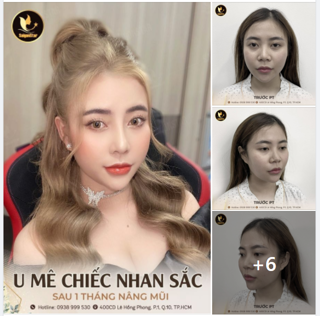 U MÊ NHAN SẮC SAU 1 THÁNG NÂNG MŨI TẠI BÁC SĨ HOẠT