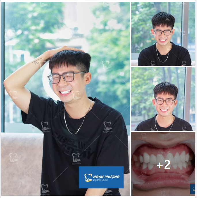 “Ún tế” nụ cười duyên dáng cùng Bách Khỉ tại nha khoa Ngân Phượng