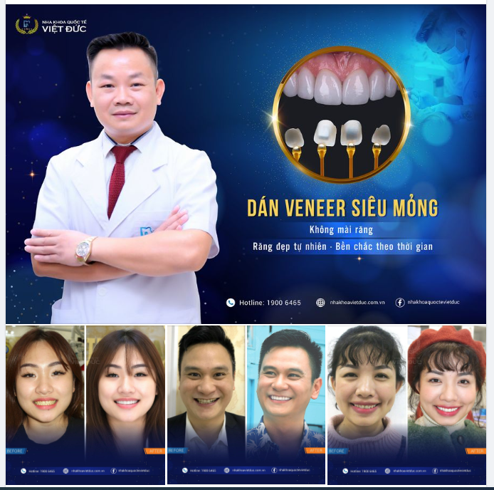 VENEER - MẶT DÁN SỨ SIÊU MỎNG BẢO VỆ RĂNG