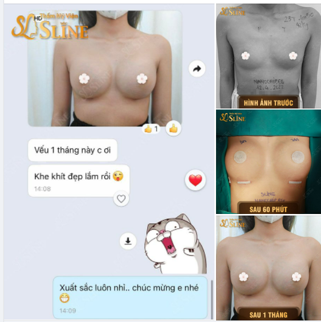 Vếu sau 1 tháng nè, khe khít đẹp lắm rồi..