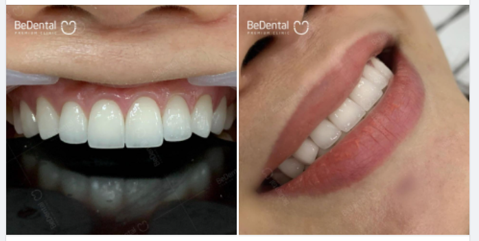 Vị khách hàng thân thiết của Nha khoa BeDental quay lại tái khám sau 3 năm kể từ khi làm răng.