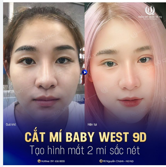 VÌ SAO CẮT MÍ KHÔNG CHẢY MÁU TẠI VQ ĐƯỢC ĐÁNH GIÁ CAO