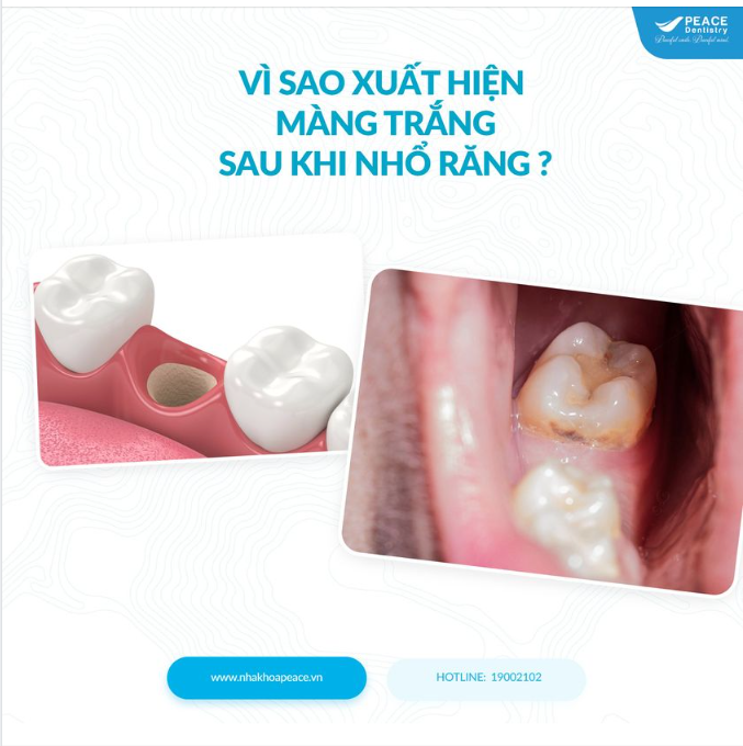 VÌ SAO XUẤT HIỆN MÀNG TRẮNG SAU KHI NHỔ RĂNG ?