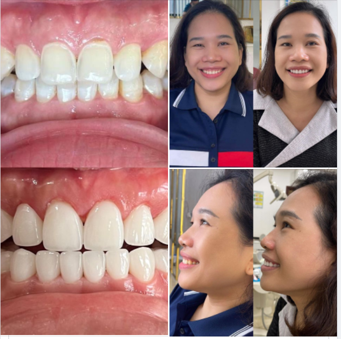 Với thẩm mỹ răng sứ yếu tố an toàn luôn được đặt lên hàng đầu!
