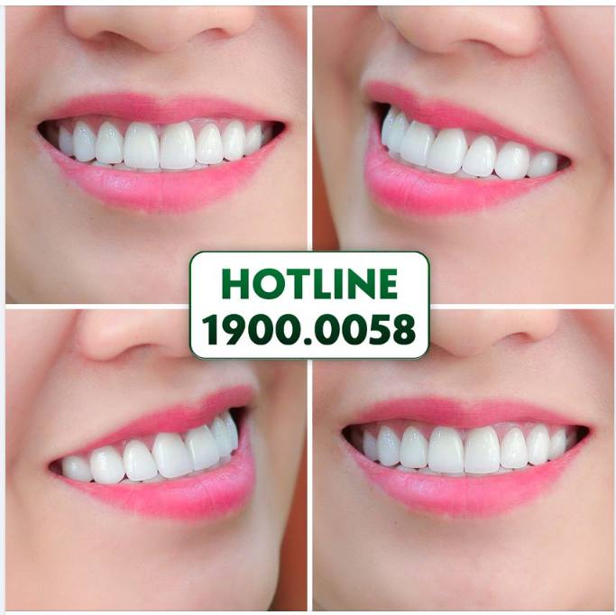 VỪA ĐẸP VỪA TỰ NHIÊN NHƯ THẾ NÀY THÌ AI NGHĨ LÀ RĂNG SỨ???