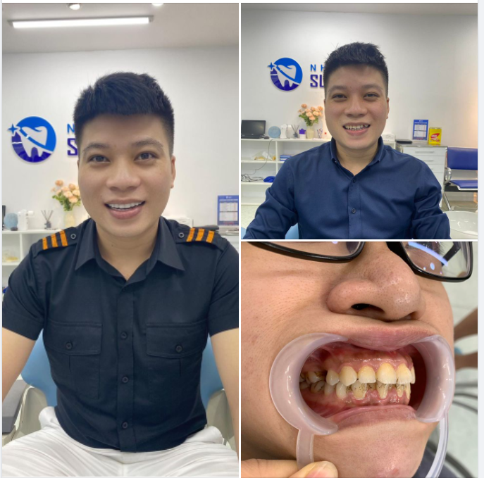 Vua lồng tiếng chọn Vua răng sứ thẩm mỹ