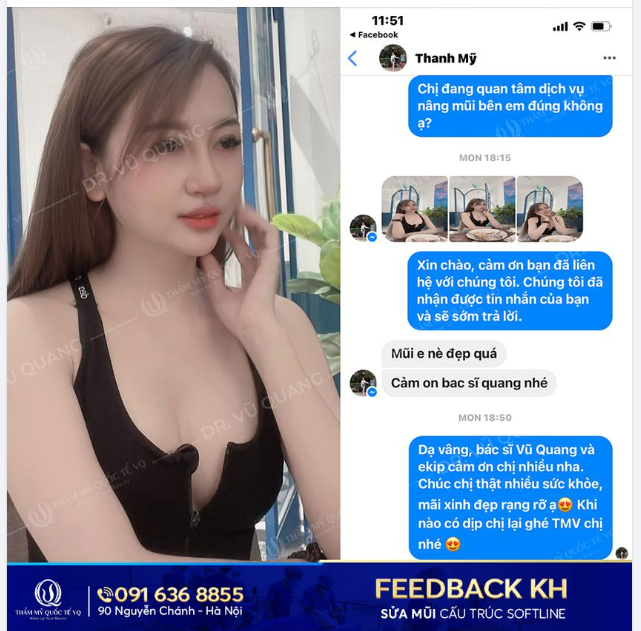 Xem ngay Feedback để có cái nhìn chân thực và chính xác nhất về dịch vụ Sửa mũi cấu trúc Softline của Dr Vũ Quang.