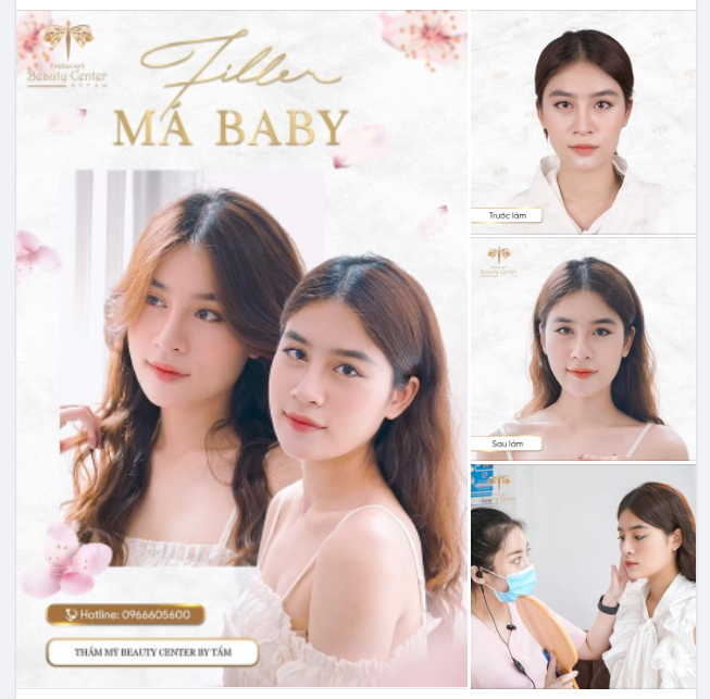 XINH ĐẸP MÊ LY NHỜ FILLER MÁ BABY