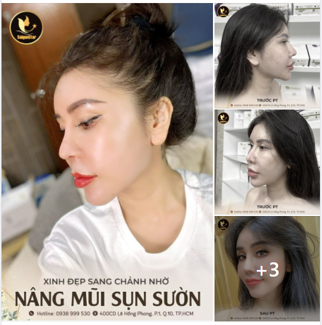 XINH ĐẸP SANG CHẢNH NHỜ NÂNG MŨI SỤN SƯỜN TẠI BS.HOẠT