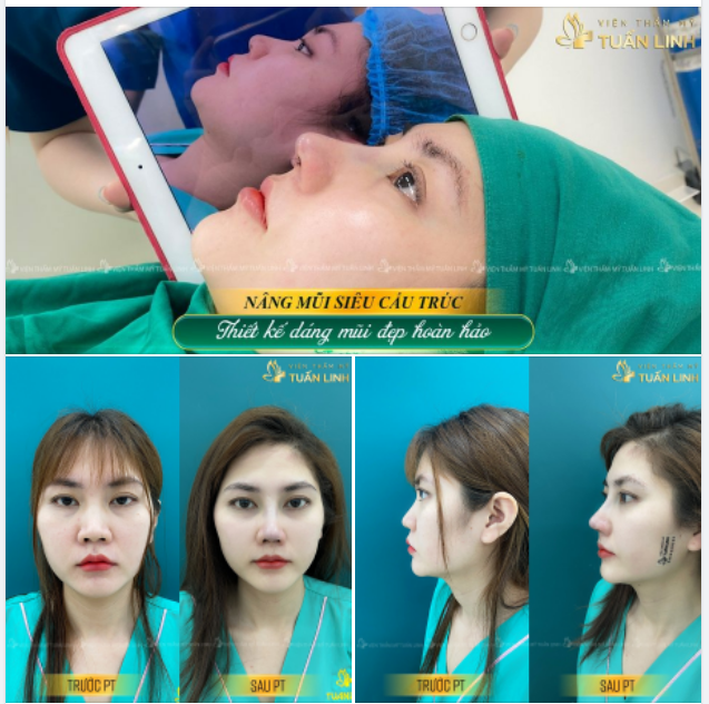 XINH HƠN, SANG HƠN SAU 90 PHÚT NÂNG MŨI SIÊU CẤU TRÚC