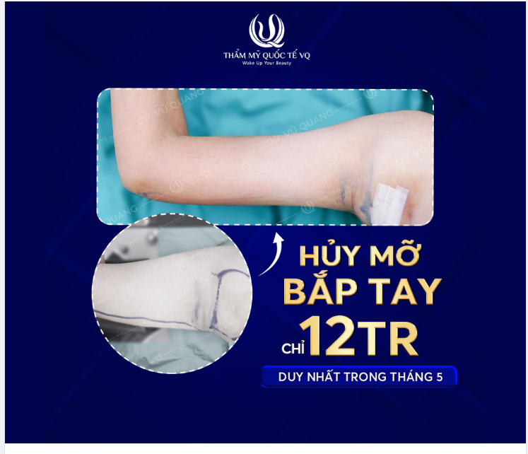 Xóa bỏ mặc cảm bắp tay cường tráng chỉ với 12tr