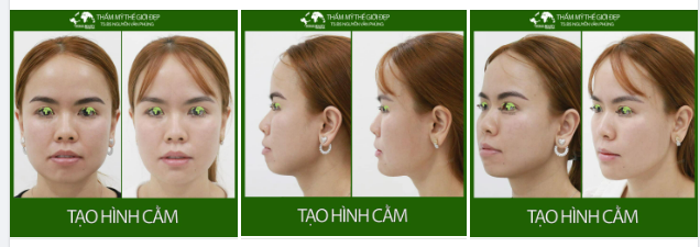 XÓA SỔ CẰM LẸM, NGẮN CHỈ VỚI PHẪU THUẬT ĐỘN CẰM