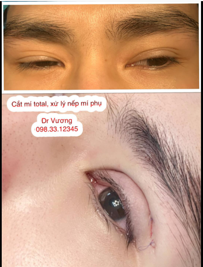 Xử lý nếp mí phụ với Dr Vương