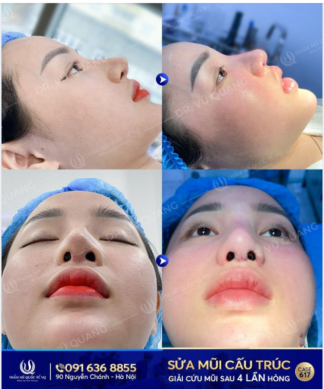 Yến Nhi 22 tuổi - Sửa mũi 4 lần tại Spa tặc và cái kết…