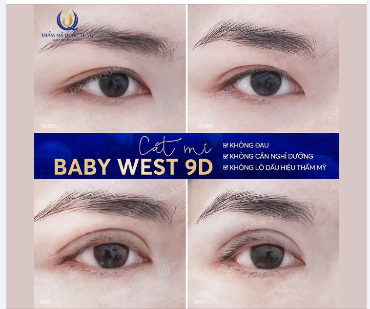 1 số lưu ý sau khi cắt mí nhất định bạn phải biết