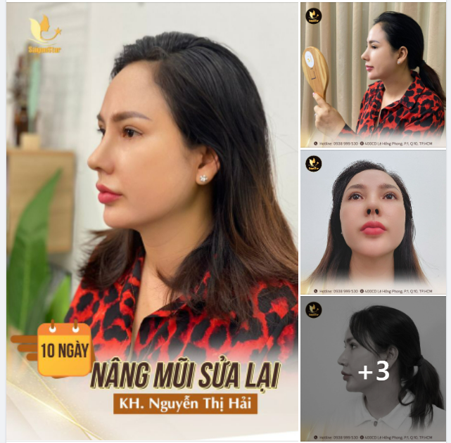 10 NGÀY NÂNG MŨI SỬA LẠI – BIẾN HÌNH CÙNG DR HOẠT KHÔNG LỘ SÓNG – KHÔNG BÓNG ĐỎ - KHÔNG LỆCH VẸO TRỤ MŨI