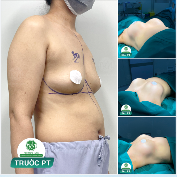 10h30 AM - CẬP NHẬT HÌNH ẢNH SAU THỰC HIỆN NÂNG NGỰC