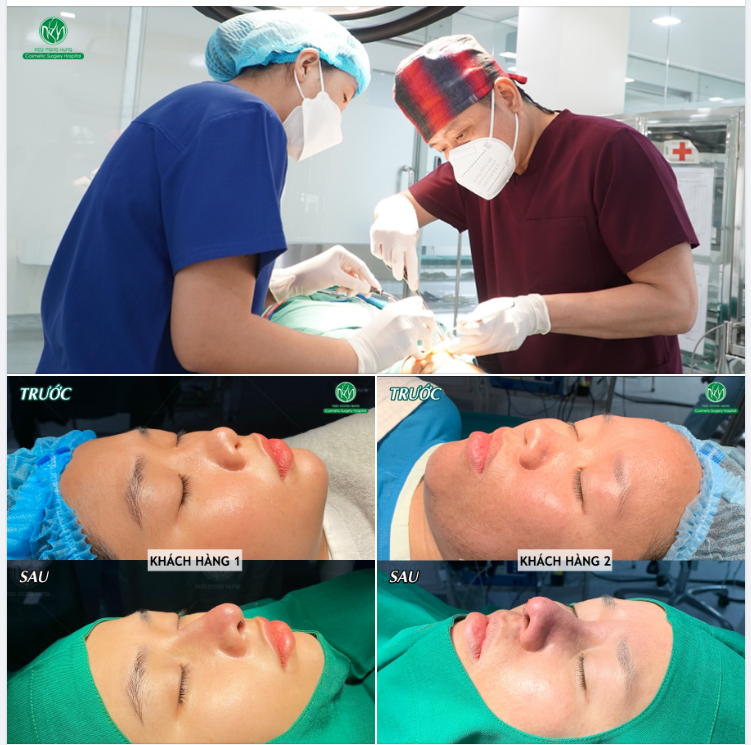 2 CA NÂNG MŨI S LINE MỚI NHẤT TẠI BỆNH VIỆN