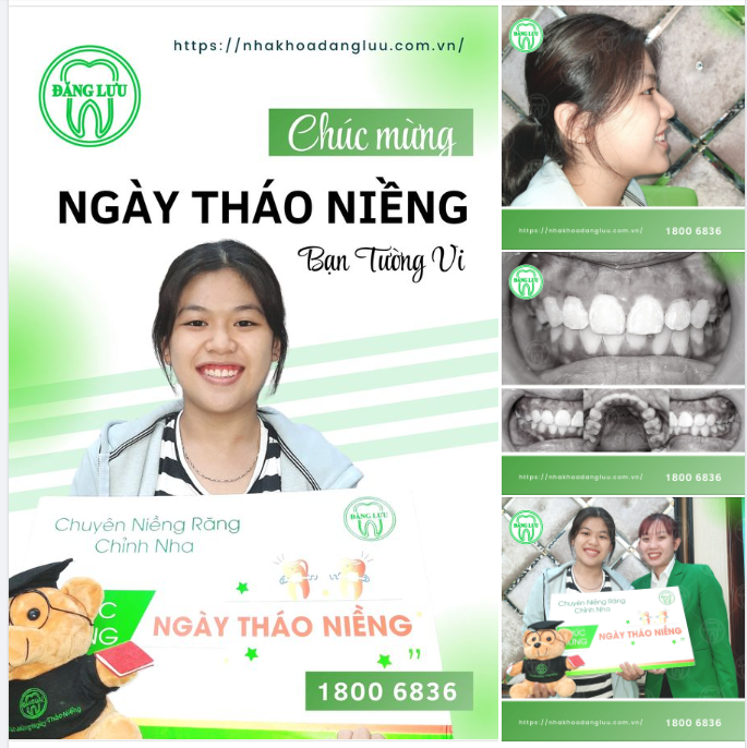 2.5 NĂM NIỀNG RĂNG, CHÚC MỪNG NGÀY THÁO NIỀNG
