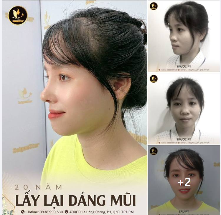 20 NĂM LẤY LẠI DÁNG MŨI
