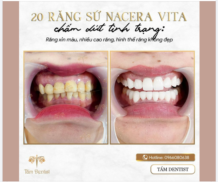 20 RĂNG SỨ NACERA VITA - CHẤM DỨT TÌNH TRẠNG RĂNG NHIỄM MÀU, HÌNH THỂ XẤU