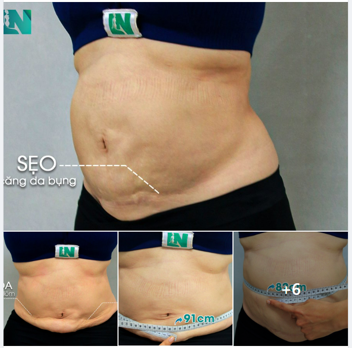 4 LẦN HÚT MỠ, 1 LẦN CĂNG DA BỤNG CHẰNG CHỊT SẸO, NGẤN MỠ LỒI LÕM KHÔNG TRỌN VẸN, CHỊ KH (SN 1966) NHỜ EKIP BÁC SĨ LƯƠNG NGỌC GIẢI CỨU; TRỰC TIẾP 15H30 – 16H30 HÔM NAY.