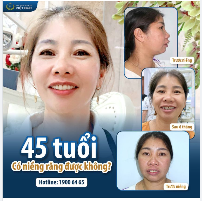 45 TUỔI NIỀNG RĂNG THÌ SAO - THÌ ĐẸP CHỨ SAO 