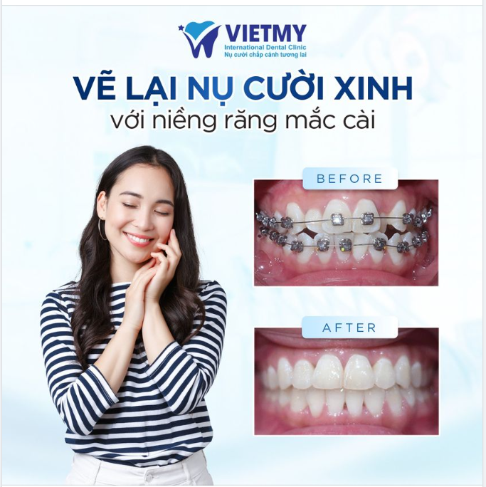 7 NỖI ĐAU SẼ BIẾN NGAY LẬP TỨC SAU KHI NIỀNG RĂNG TẠI NHA KHOA QT VIỆT MỸ