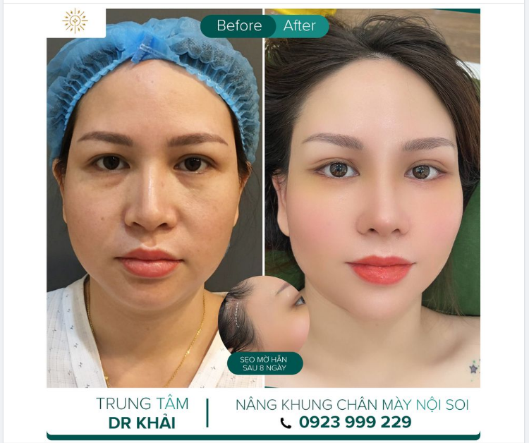 8 NGÀY LỘT XÁC VỚI DV NÂNG KHUNG CHÂN MÀY NỘI SOI - KĨ THUẬT ĐỘC QUYỀN TRUNG TÂM BS Đỗ Quang Khải.