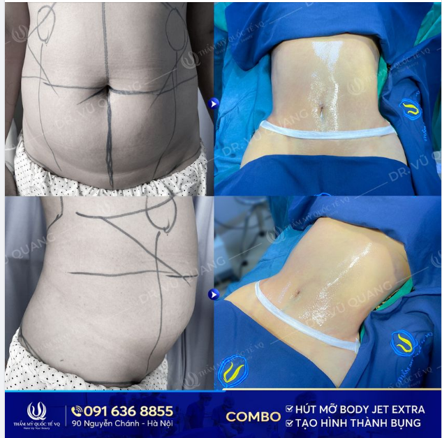 90P Siết gọn thân hình với Combo Hút mỡ Body Jet Extra ​​​​​​​ Tạo Hình thành bụng.