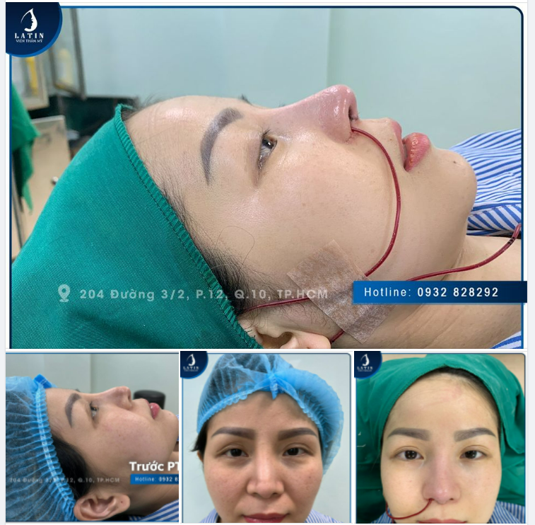 Ai nói đầu mũi mỏng thì không nâng mũi được nào