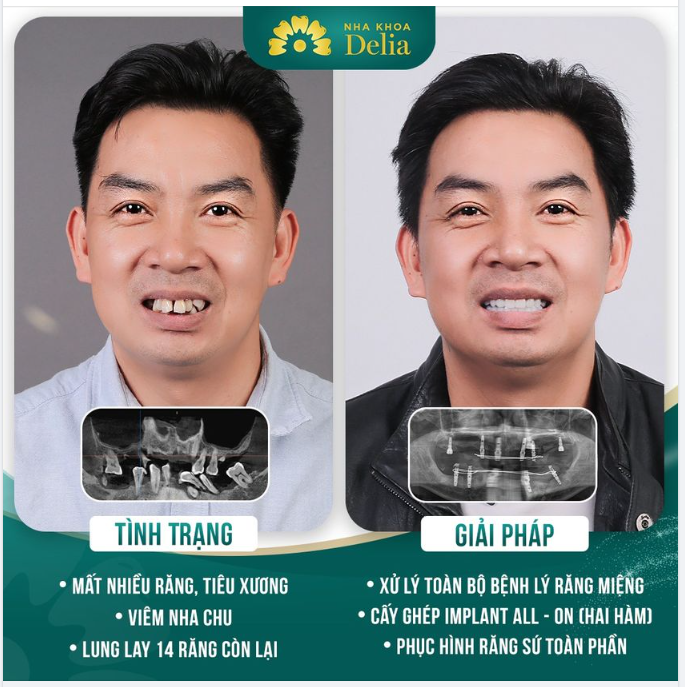 Anh Lưu  gặp nhiều khó khăn ăn nhai, thiếu tự tin trong giao tiếp, ảnh hưởng nhiều tới sinh hoạt hằng ngày của mình.