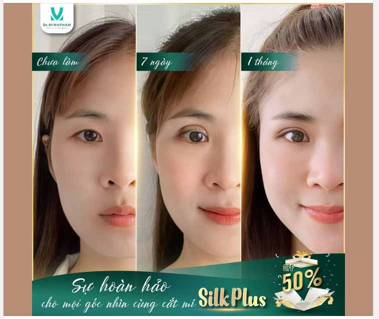 Ánh mắt mê hồn với cắ.t mí Silk Plus