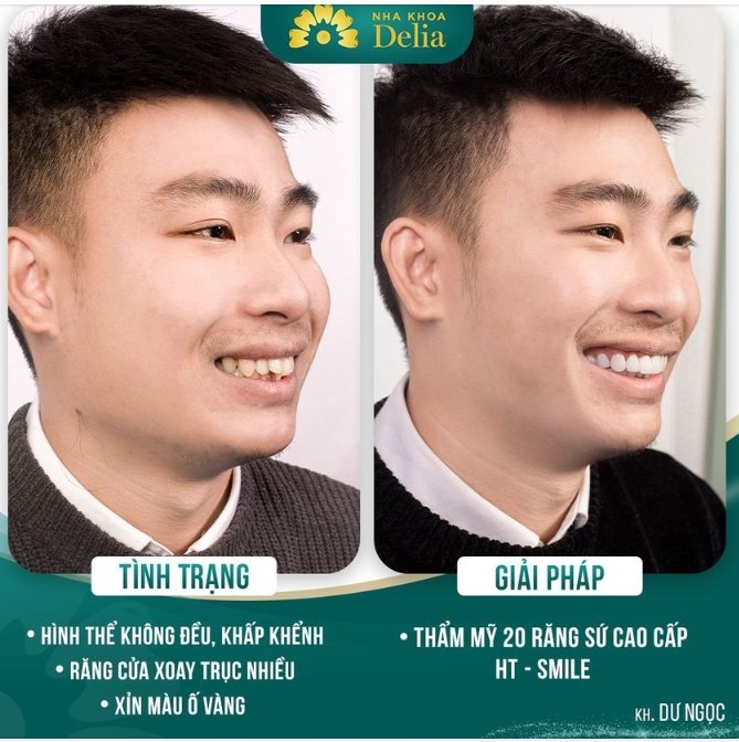Anh Ngọc hóm hỉnh chia sẻ: "Đội ngũ nhân viên Delia tâm huyết thật, mình rất hài lòng. Giờ mình chỉ thích soi gương vì cũng tự thấy đẹp trai hơn hẳn!"