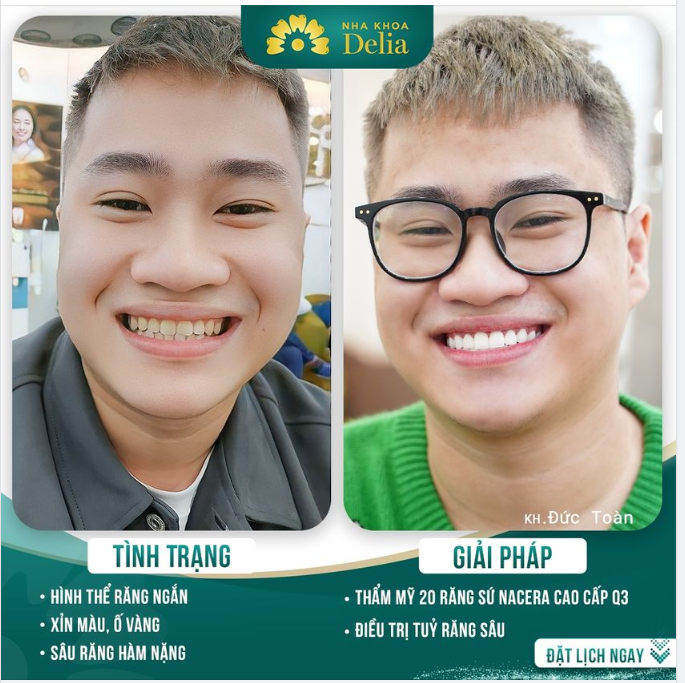 Anh Toàn chia sẻ vì chưa thực sự tự tin với nụ cười của mình và mong muốn được cải thiện khuyết điểm.