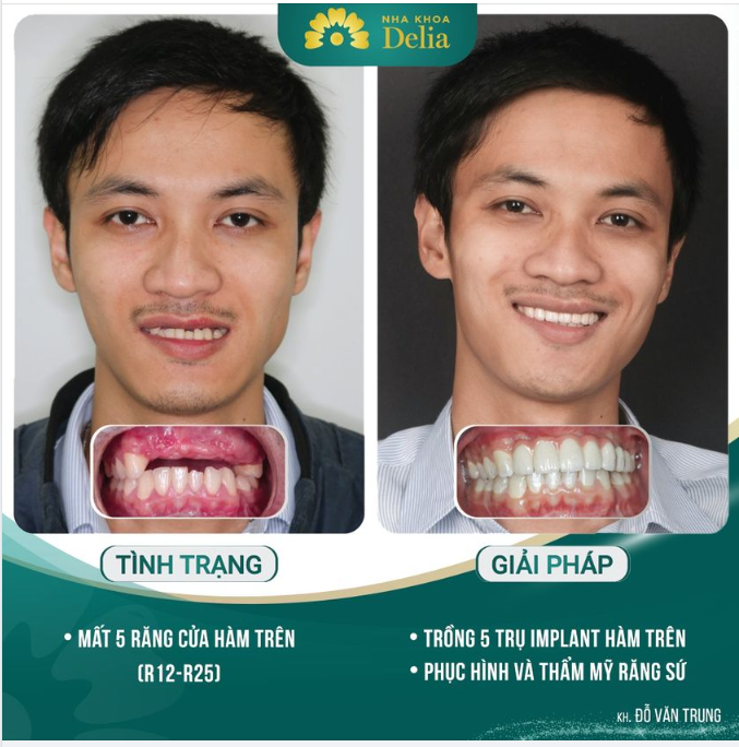 Anh Trung đến Delia với mong muốn có giải pháp khắc phục sớm, tránh để lại nhiều biến chứng và bất tiện trong sinh hoạt, giao tiếp sau này.