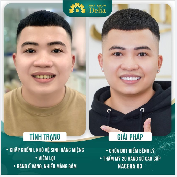 Anh Vũ quyết định đến Delia để khắc phục tình trạng và cải thiện sức khoẻ răng miệng của mình.