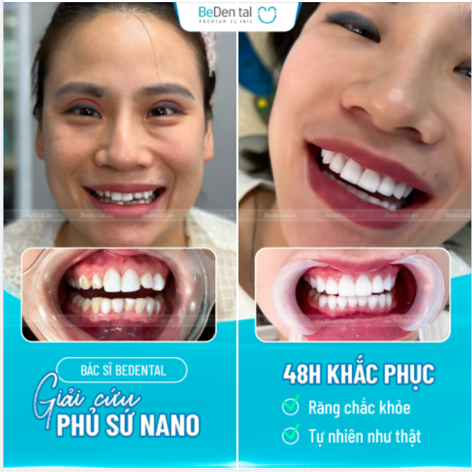 Bác sĩ Bedental giải cứu case phủ sứ Nano cho chị khách chi nhánh Sài Gòn