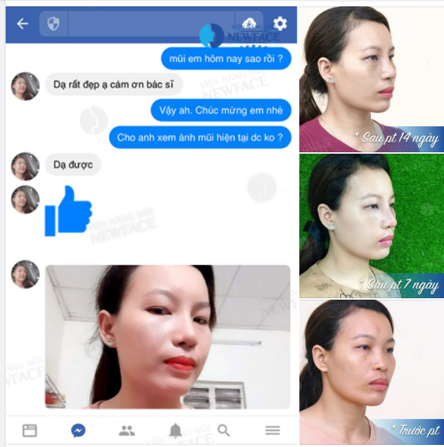 Bạn ấy ĐƯỢC GÌ và MẤT GÌ khi chọn NÂNG MŨI CẤU TRÚC