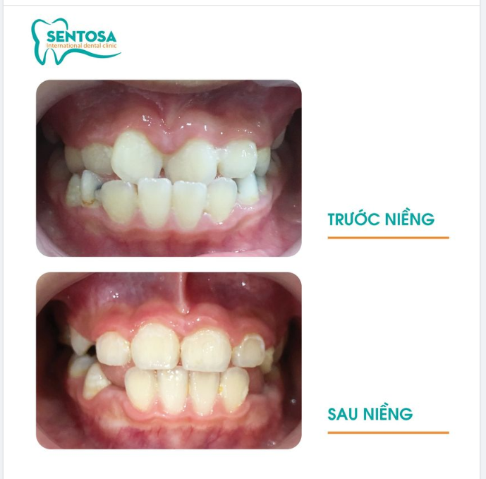 BẠN ĐÃ BIẾT VỀ LỢI ÍCH CỦA VIỆC TẦM SOÁT KHỚP CẮN SỚM CHO CON?