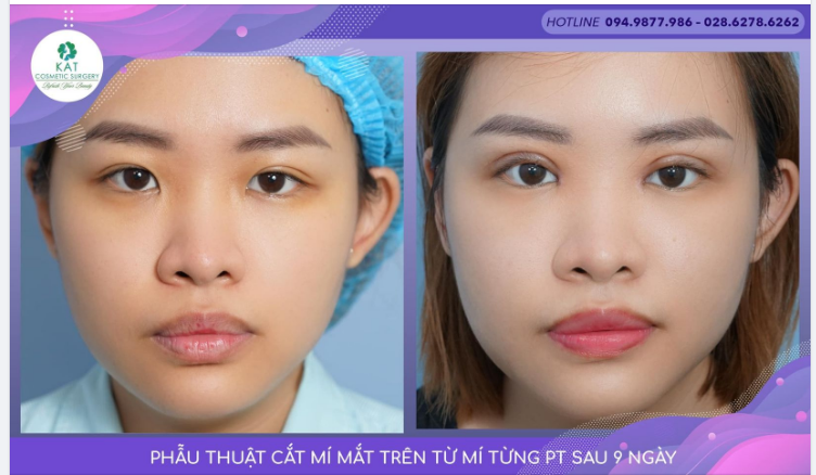 Bạn khách đến muốn chỉnh lại đôi mắt cũ không đều do lần sửa trước, da dư và nếp mí không đều.