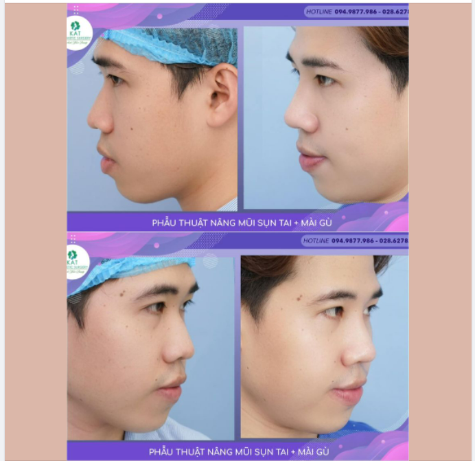 ​​​​​​​ Bạn khách hàng Nam đến với KAT với mong muốn chỉnh sửa chiếc mũi bị thấp và gồ ghề.