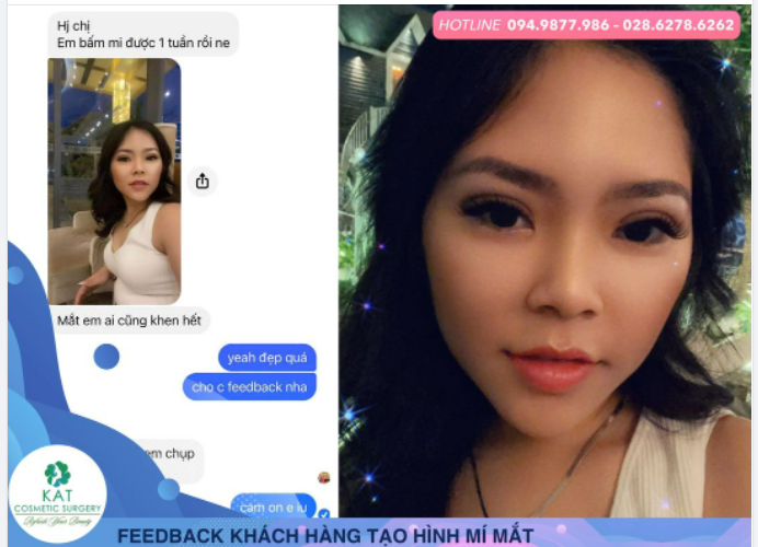 Bạn khách yêu quý sau khi thực hiện phẫu thuật bấm mí tại KAT chỉ sau 1 tuần đã vô cùng xinh đẹp và tự nhiên.