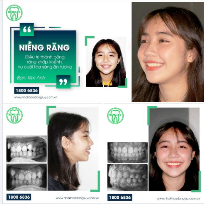 Bạn Kim Anh có răng số 3 mọc lệch cao ảnh hưởng đến thẩm mỹ nụ cười, vệ sinh răng miệng & sức khỏe răng về lâu dài.