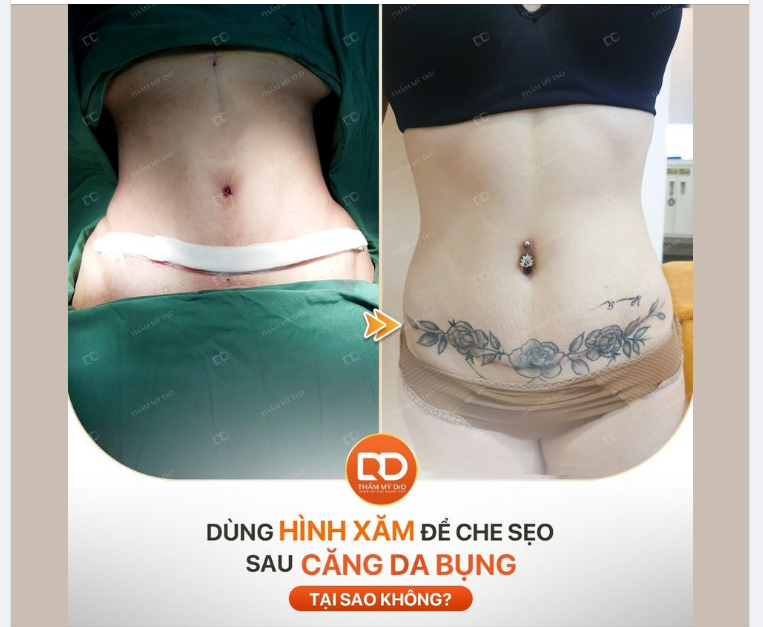 Bạn lo lắng bị lộ sẹo sau phẫu thuật CĂNG DA BỤNG