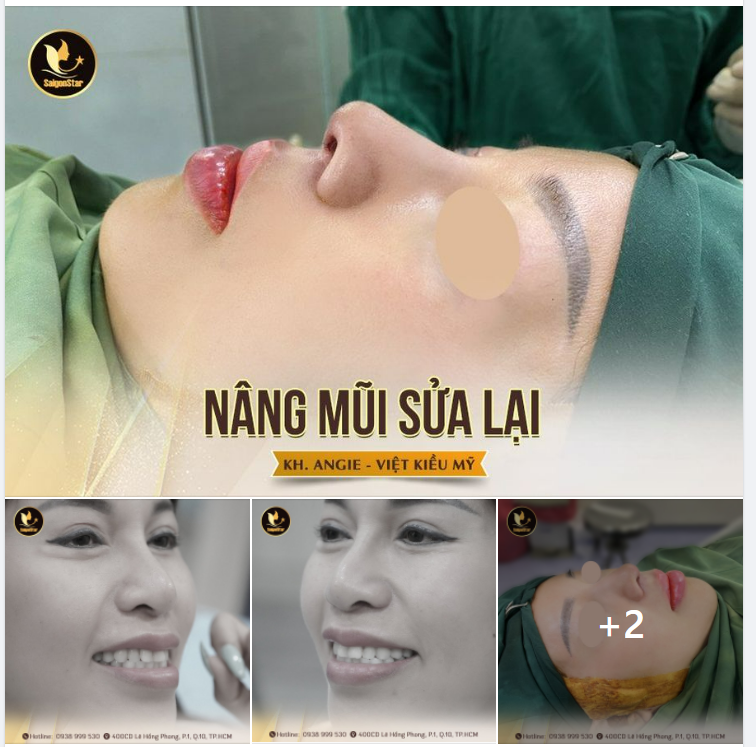 BAY NỬA VÒNG TRÁI ĐẤT – KẾT QUẢ CỰC ƯNG Ý NÂNG MŨI SỬA LẠI CHO CHỊ PHƯƠNG ANH (ANGIE) VIỆT KIỀU MỸ