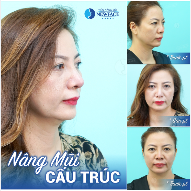 BIẾN CHỨNG NHỌN, ĐỎ ĐẦU MŨI SẼ TRÔNG NHƯ THẾ NÀY ĐÂY!