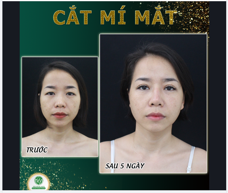 BIẾT VẬY ĐÃ ĐI CẮT MÍ SỚM HƠN ...