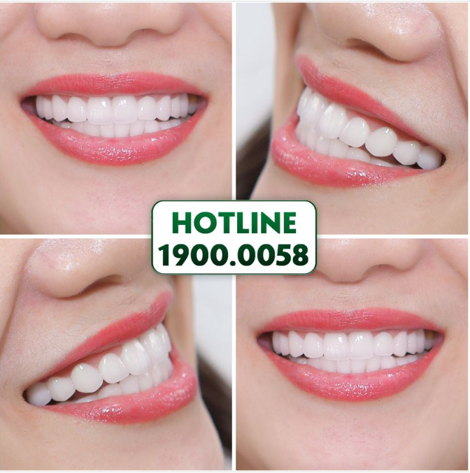 BỘ RĂNG SỨ THẨM MỸ ĐƯỢC THỰC HIỆN BỞI CHÍNH TAY CHUYÊN GIA TRÊN 17 NĂM KINH NGHIỆM